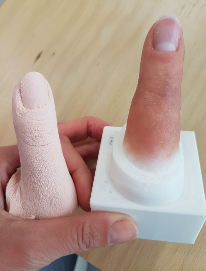 proteza estetyczna palca