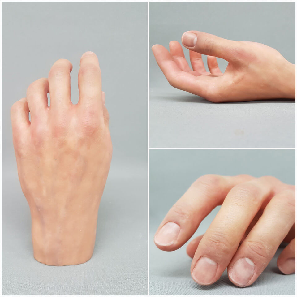 proteza estetyczna dłoni