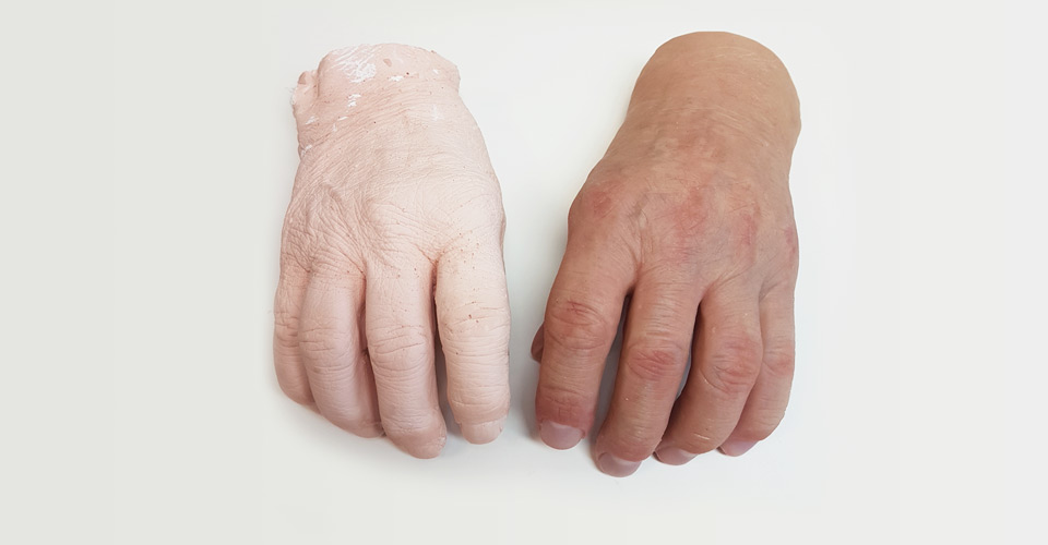 proteza estetyczna dłoni